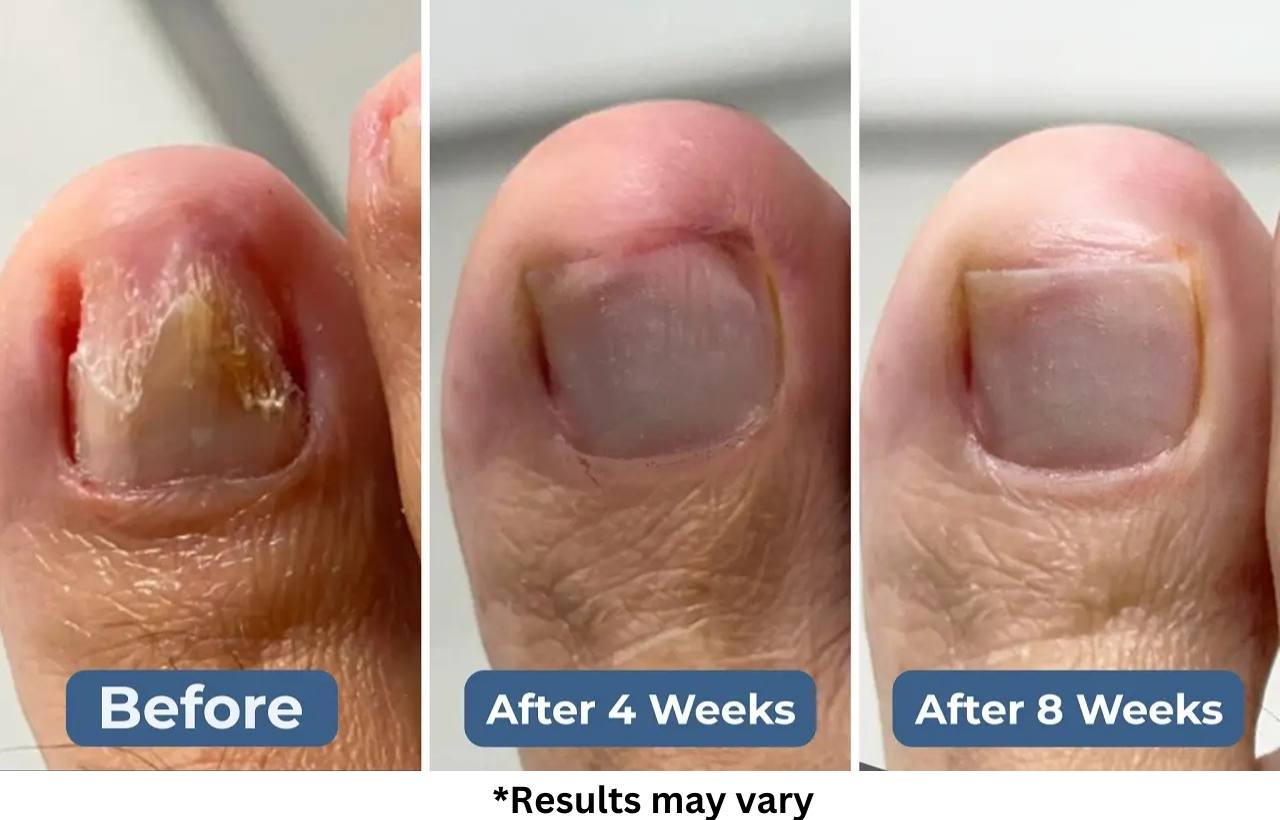 Case #1: 7 Years of Fungus—Gone in 8 Weeks