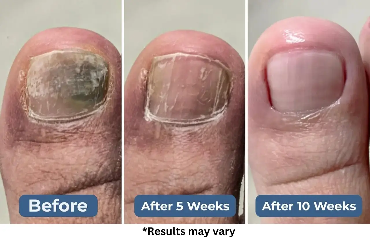 Case #3: An Athlete Crippled by Toenail Fungus Is Running Again After 10 Weeks