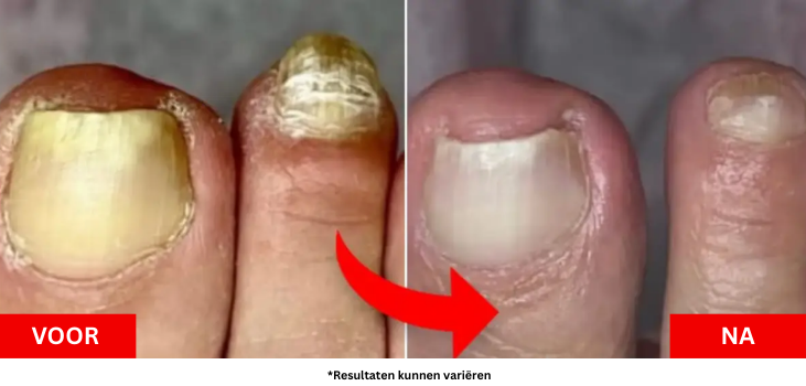 Waarom de meeste schimmelbehandelingen niet werken