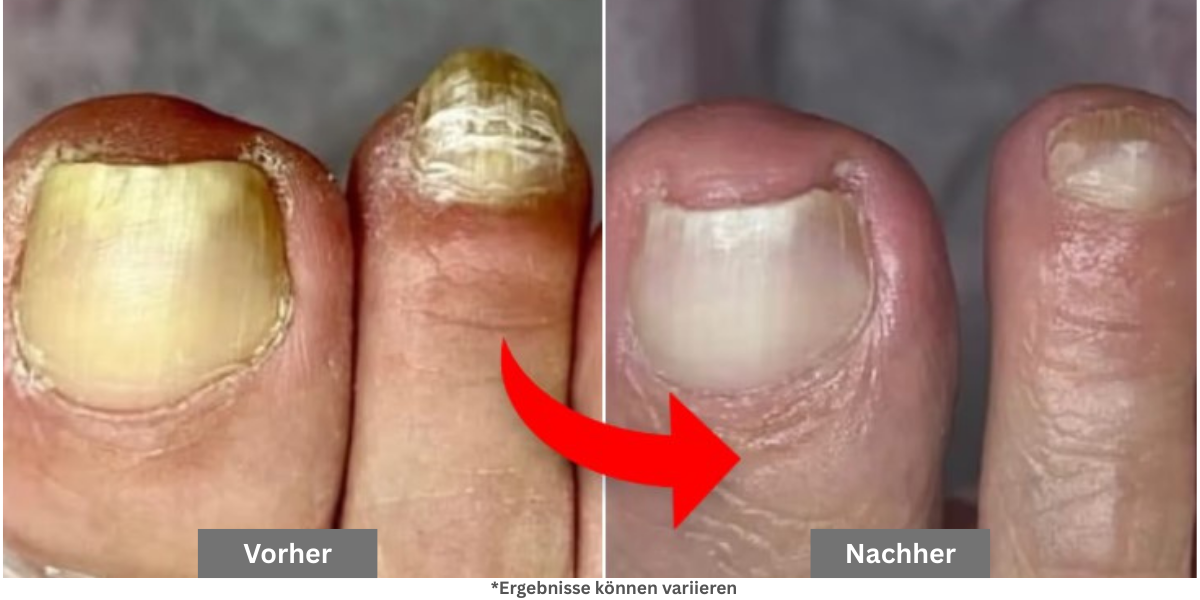 Warum die meisten Nagelpilz-Behandlungen nicht funktionieren