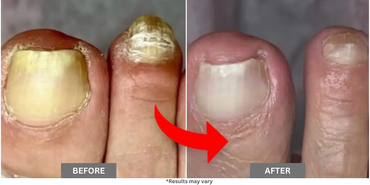 Why Most Fungus Treatments Don’t Work