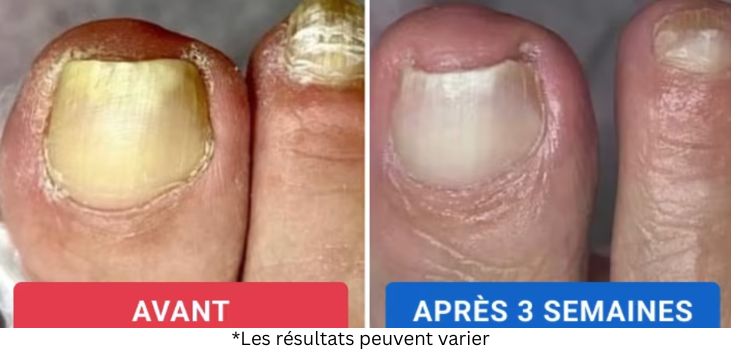 Pourquoi la plupart des traitements contre les mycoses ne fonctionnent pas