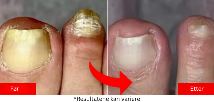 Hvorfor de fleste behandlinger mot neglesopp ikke fungerer