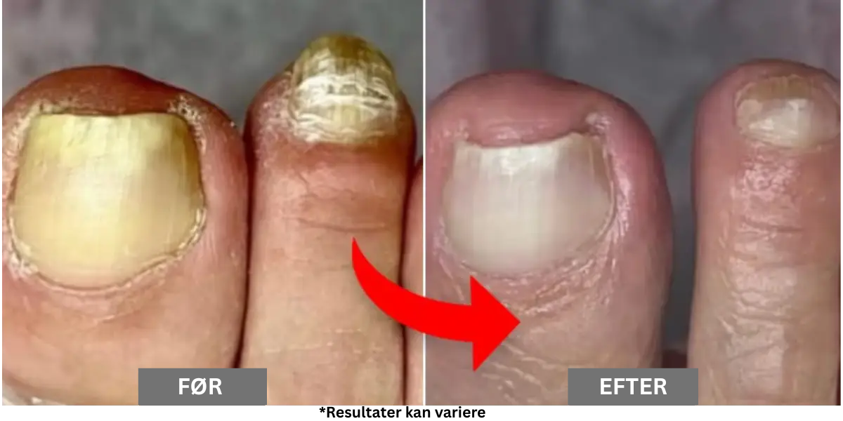 Hvorfor de fleste behandlinger mod neglesvamp ikke virker