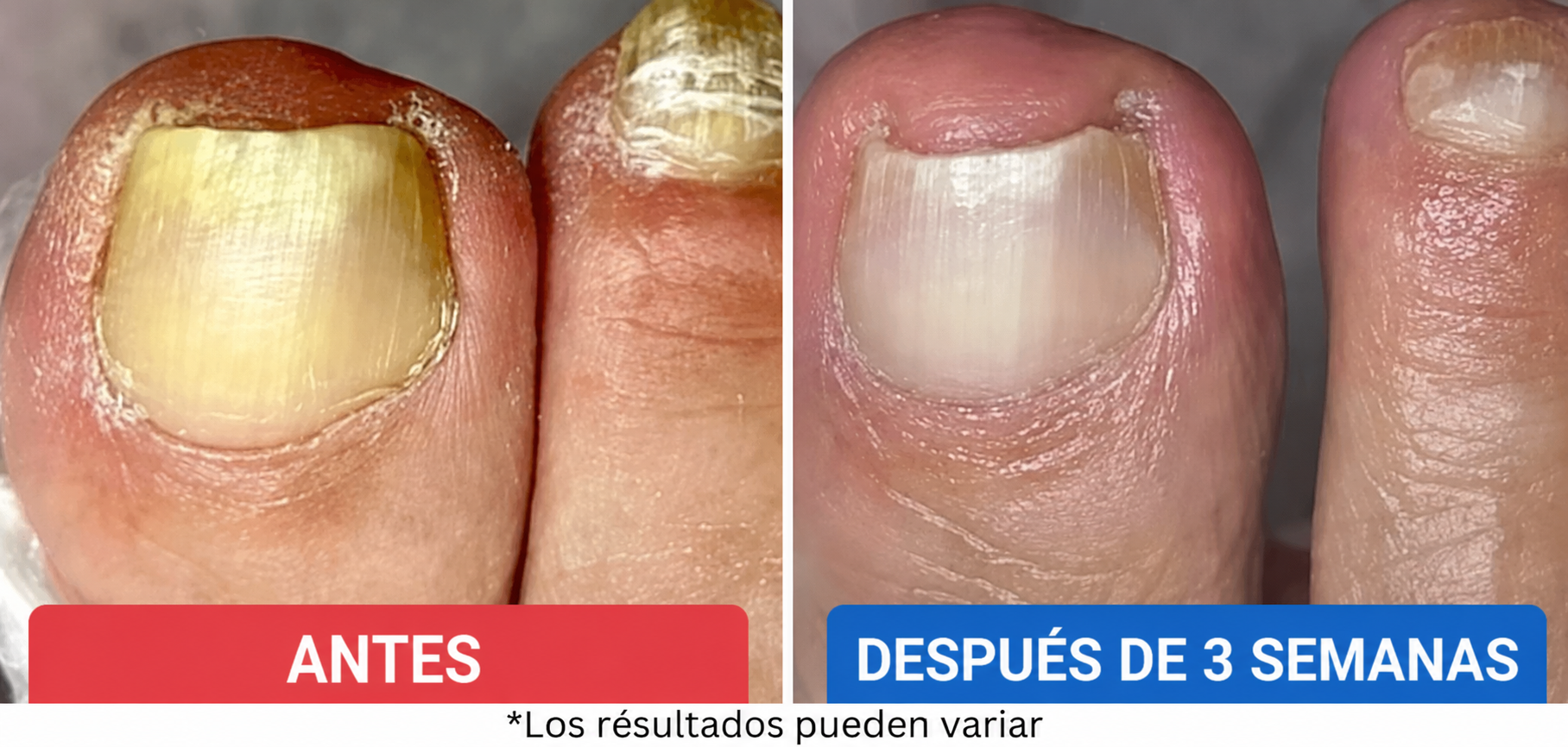 Por qué la mayoría de los tratamientos contra los hongos en las uñas no funcionan