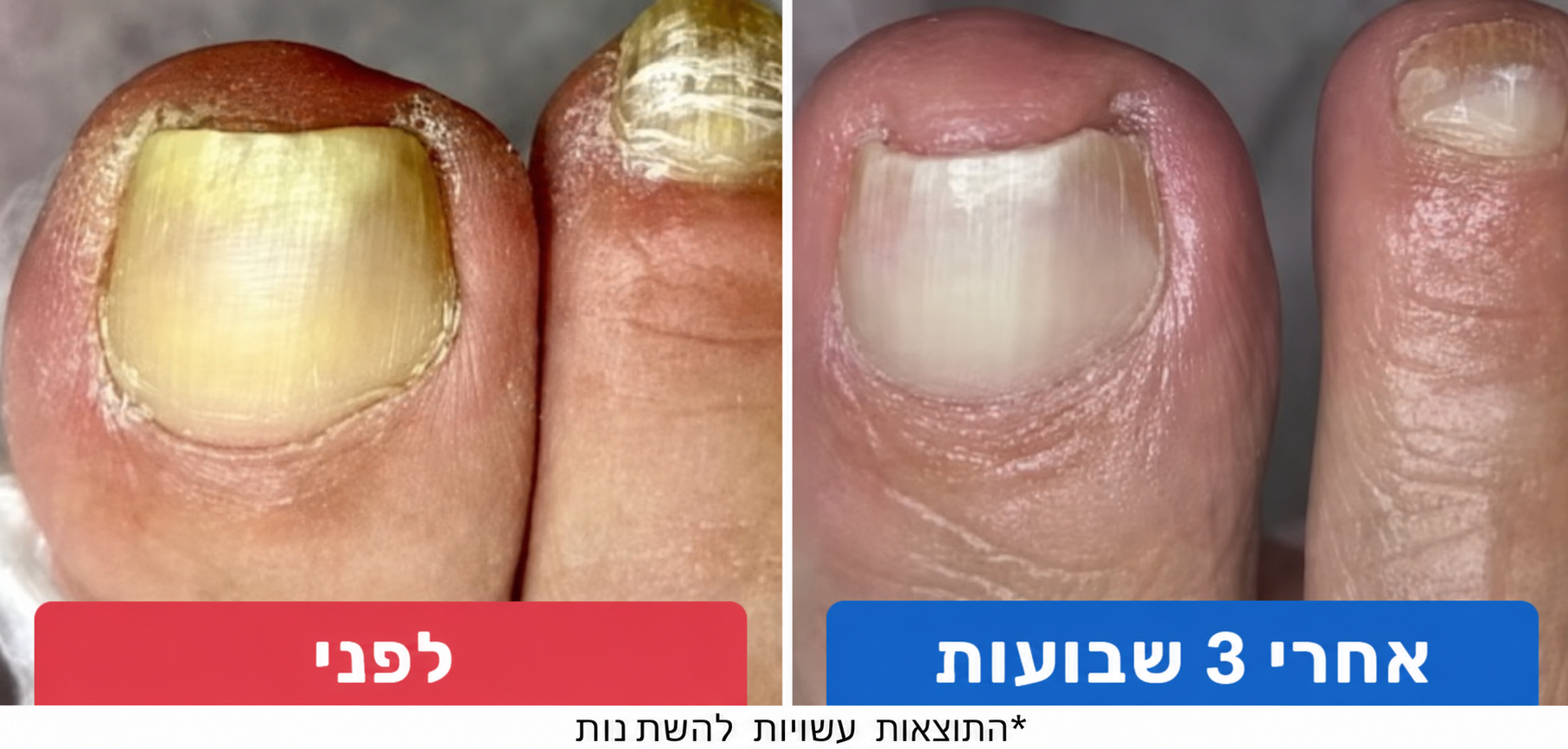למה רוב הטיפולים בפטרת הציפורניים לא עובדים