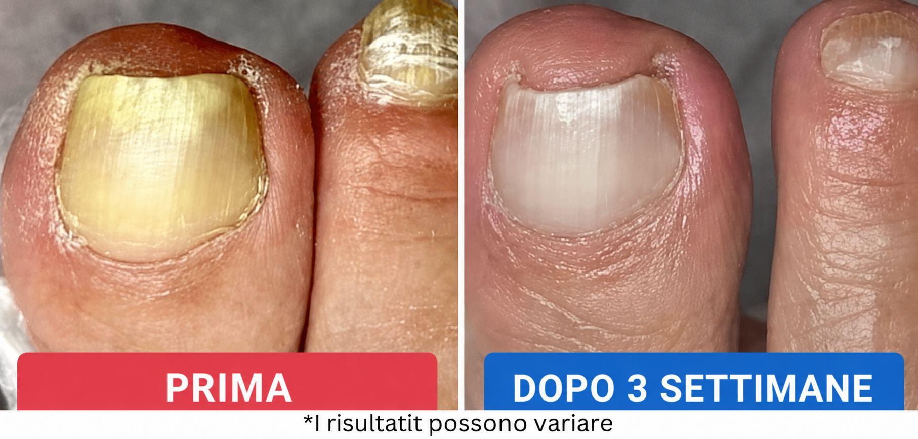 Perché la maggior parte dei trattamenti contro la micosi non funziona