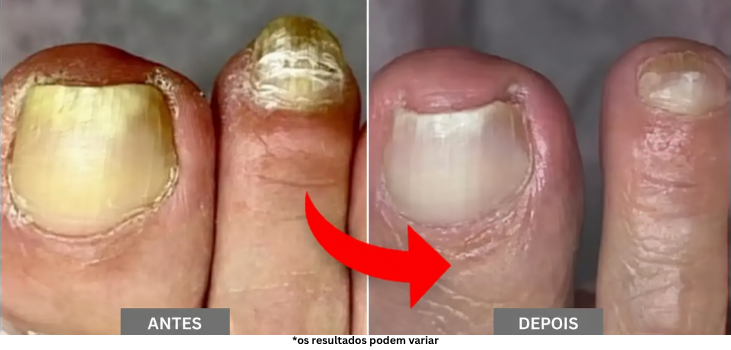 Porque É Que a Maioria dos Tratamentos Contra Fungos Não Funciona